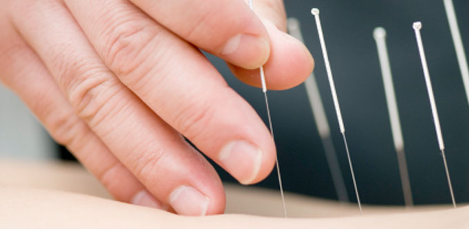 ACUPUNCTURE