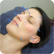 Cosmetic Acupunture & Facial Rejuvenation Brisbane