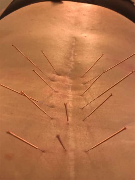 SCAR RESTORATION ACUPUNCTURE